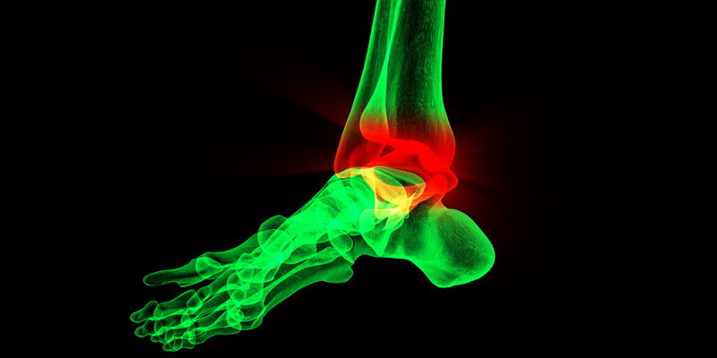 Dolor interno de tobillo secundario a hiperpronación (iStock)