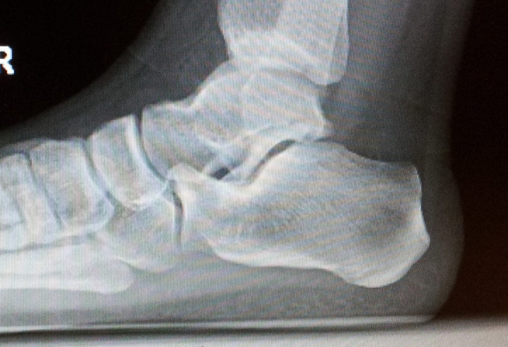 Calcificación calcánea posterior.
