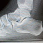 Calcificación en el talón: diagnóstico y tratamiento Calcificación calcánea posterior.