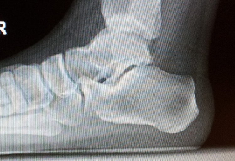 Calcificación calcánea posterior.