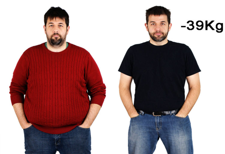 Antes y después de un paciente con balón intragástrico (IMEO)