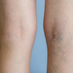 6 tratamientos efectivos para eliminar las varices Varices