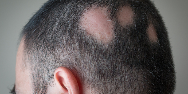 alopecia