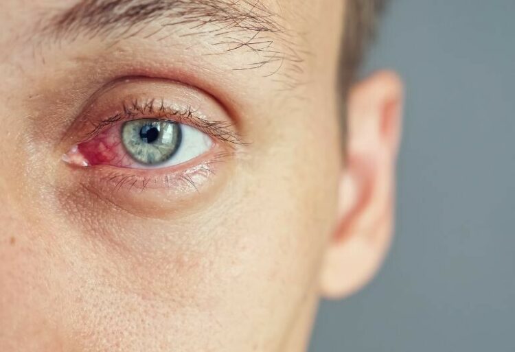 Queratitis qué es, síntomas y tratamiento (Adobe Stock)